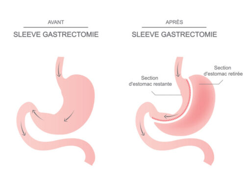 Sleeve gastrectomie